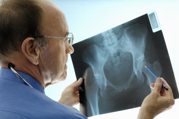 Orthopedic surgeon consulting pelvic x-rays for a hip replacement